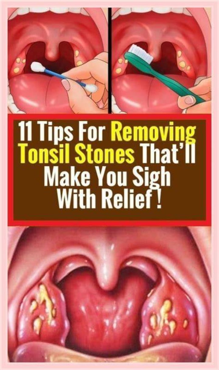How do you dissolve tonsil stones naturally?