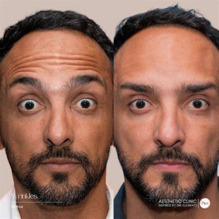 Is 46 too old to start Botox?