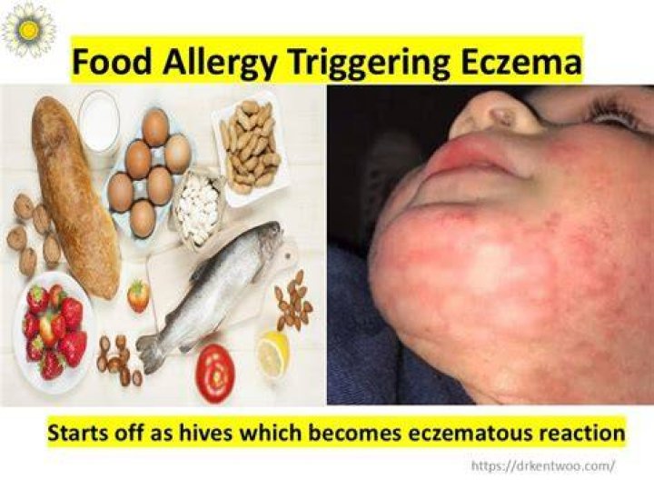 What foods trigger dermatitis?