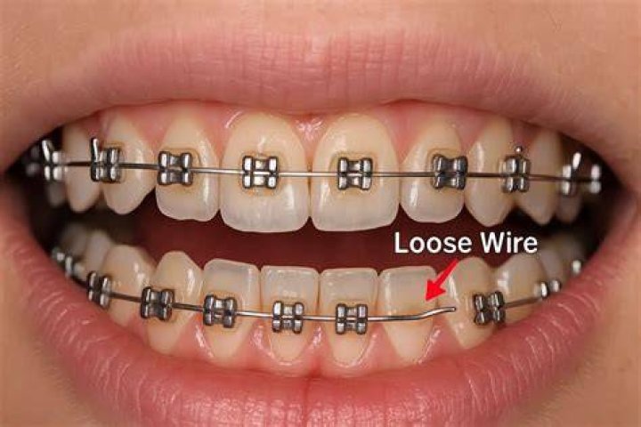 What is the thinner wire for braces?