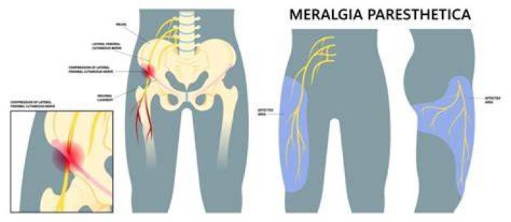 What kind of doctor treats meralgia paresthetica?