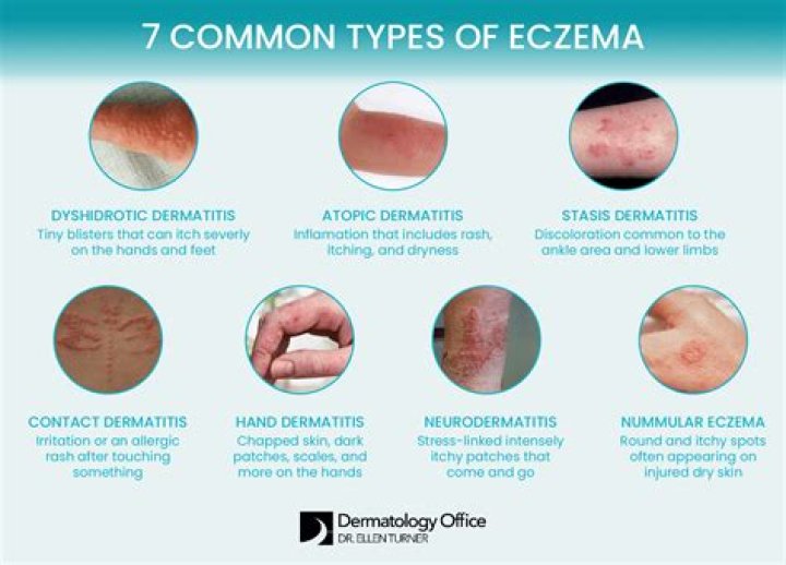 What will a dermatologist do for eczema?