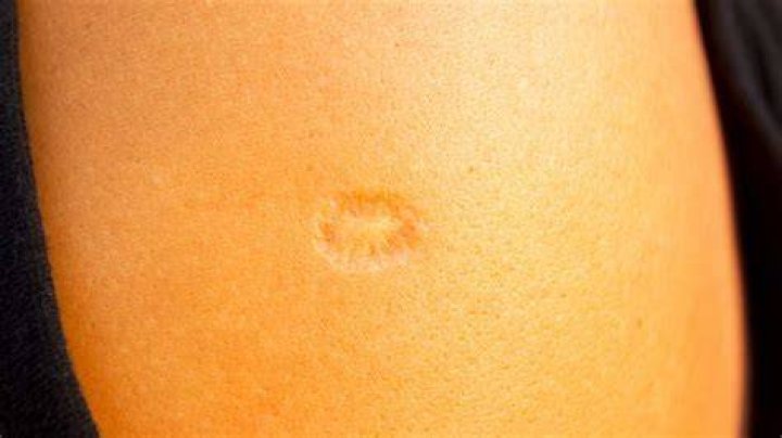 Which vaccine left a scar on your shoulder?