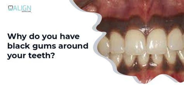 Why is my gum turning black?