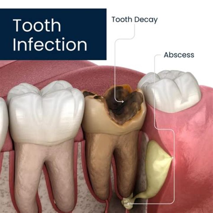 Will an infected tooth stop hurting?